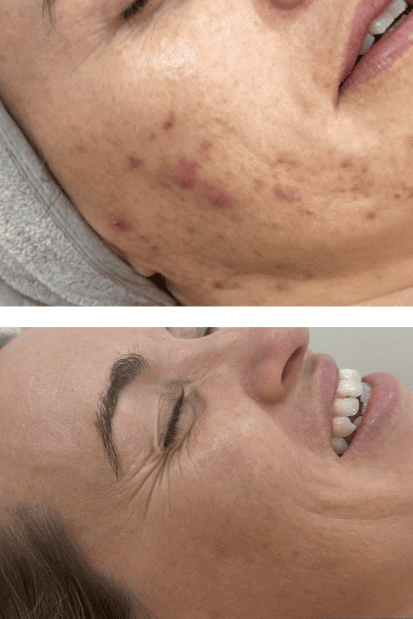 acne 4 1