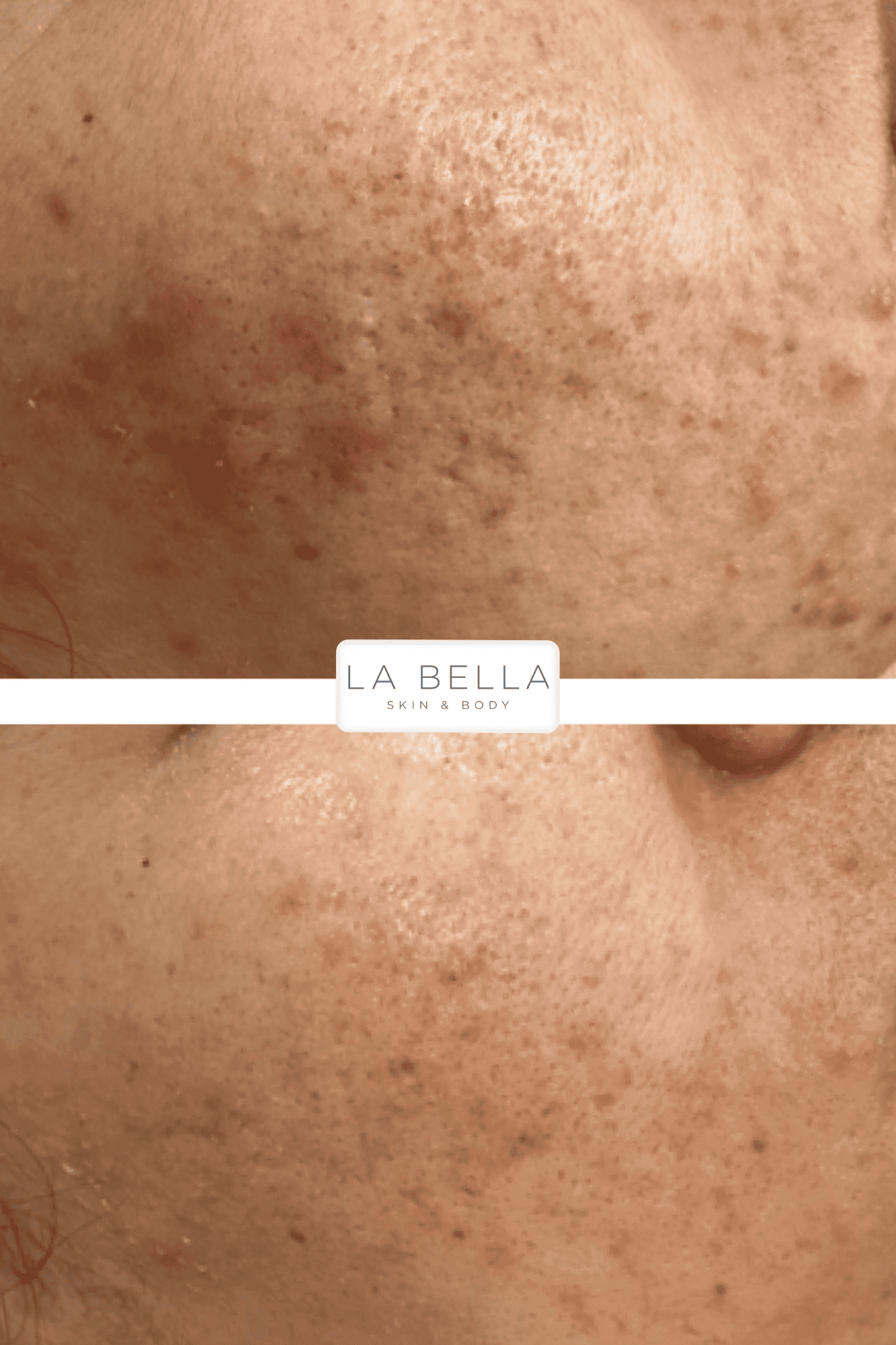 acne 5 1