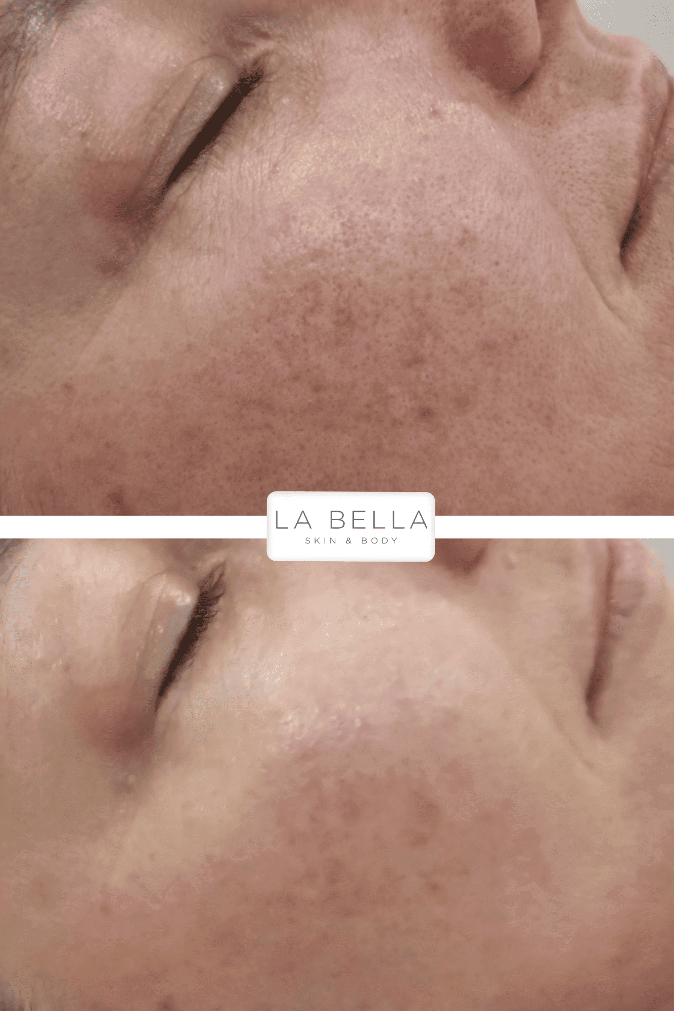 Impaired Barrier slight Rosacea