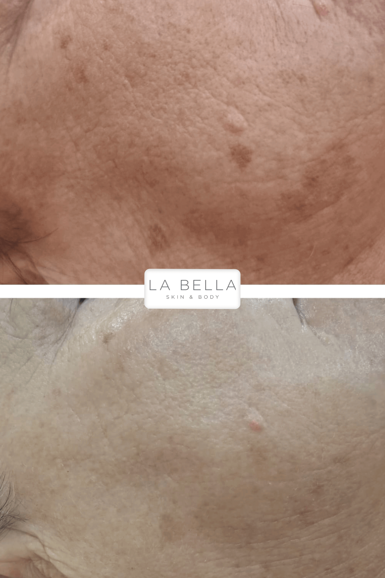 Pigmemt melasma 2