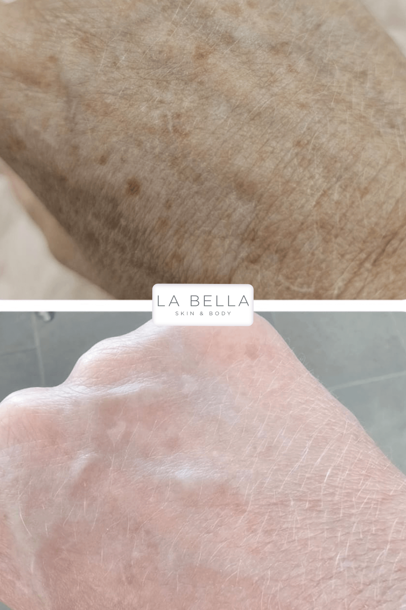 Pigmemt melasma