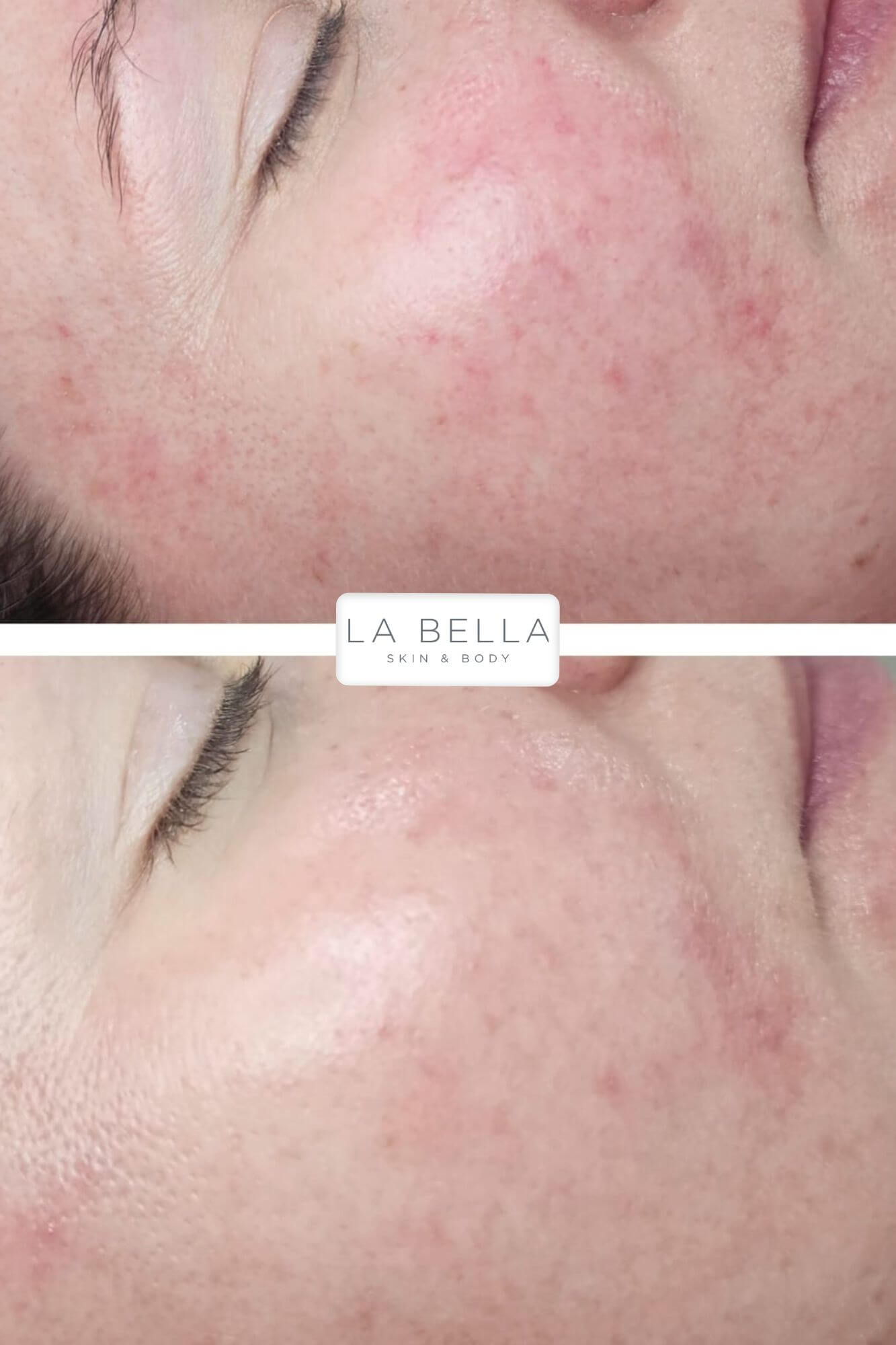 redness Rosacea